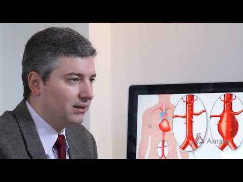 Aneurismas de Aorta: Dr. Alexandre Amato